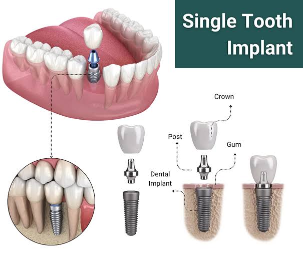 24-Hour Dental Implant in Thane: A Real Patient Case from Germany